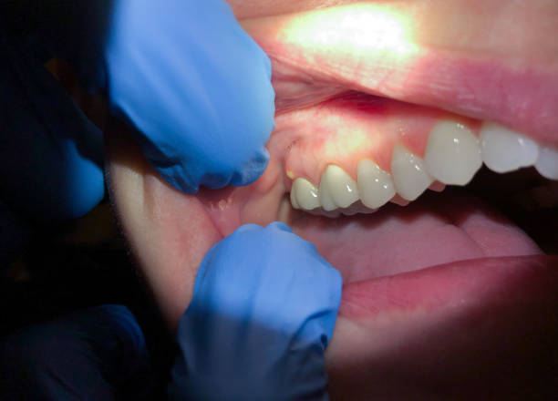 Best Chipped Tooth Repair Near Me  in Wenonah, NJ